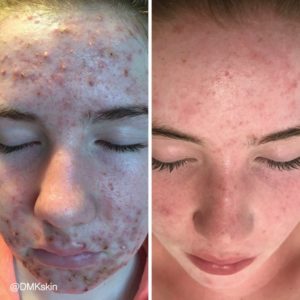 Combat Your Acne This Winter For Glowing Skin Come Summer