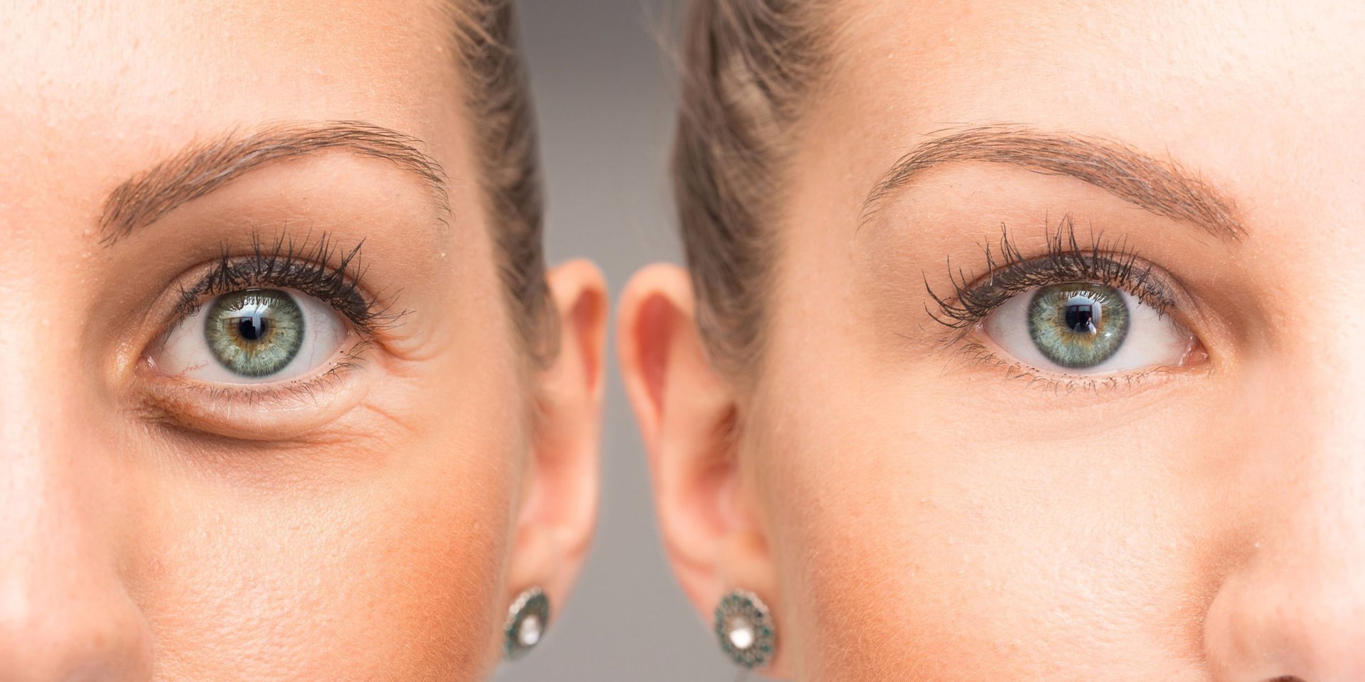 eyelid surgery auckland