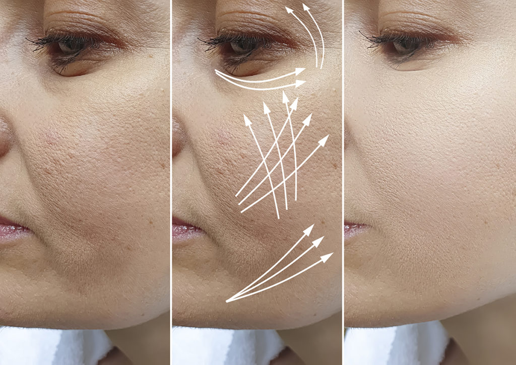 How to Create a Naturally Younger-Looking Face With Dermal Fillers