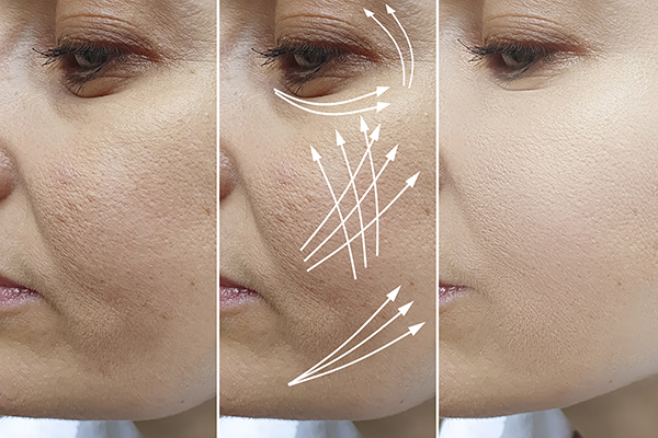 How to Create a Naturally Younger-Looking Face With Dermal Fillers