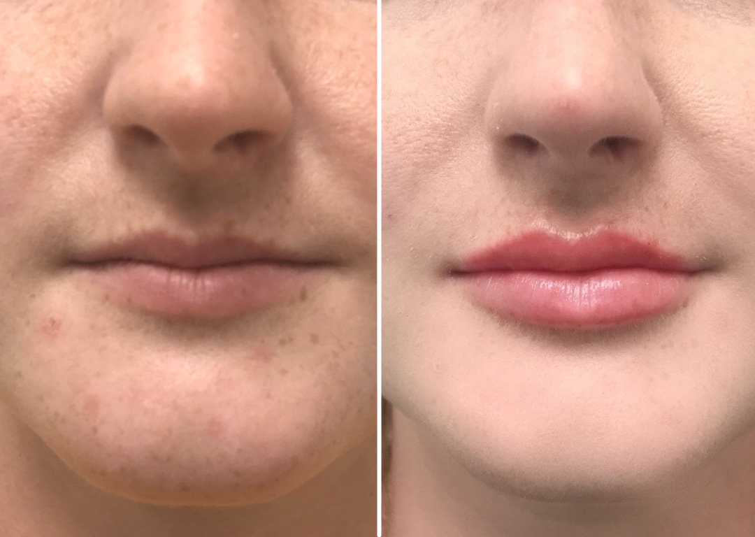 Shaping Lips With Fillers