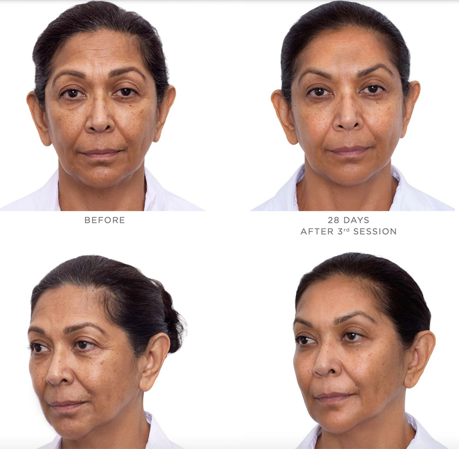Sculptra Before After 3