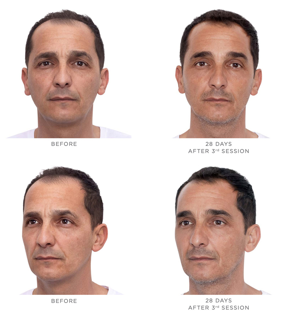 Sculptra Before After 4